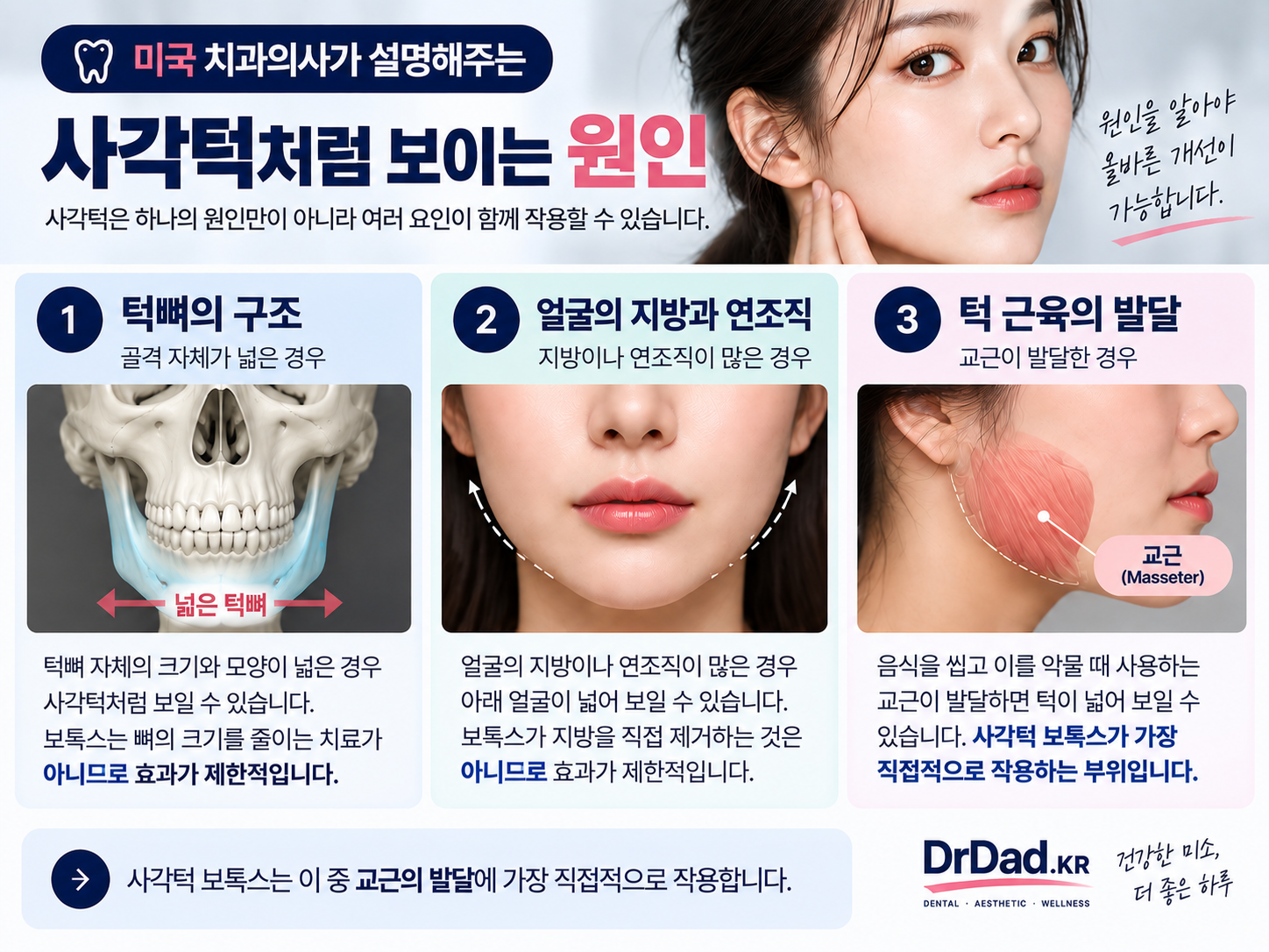 사각턱처럼 보이는 원인 턱뼈 지방 연조직 교근 설명 인포그래픽