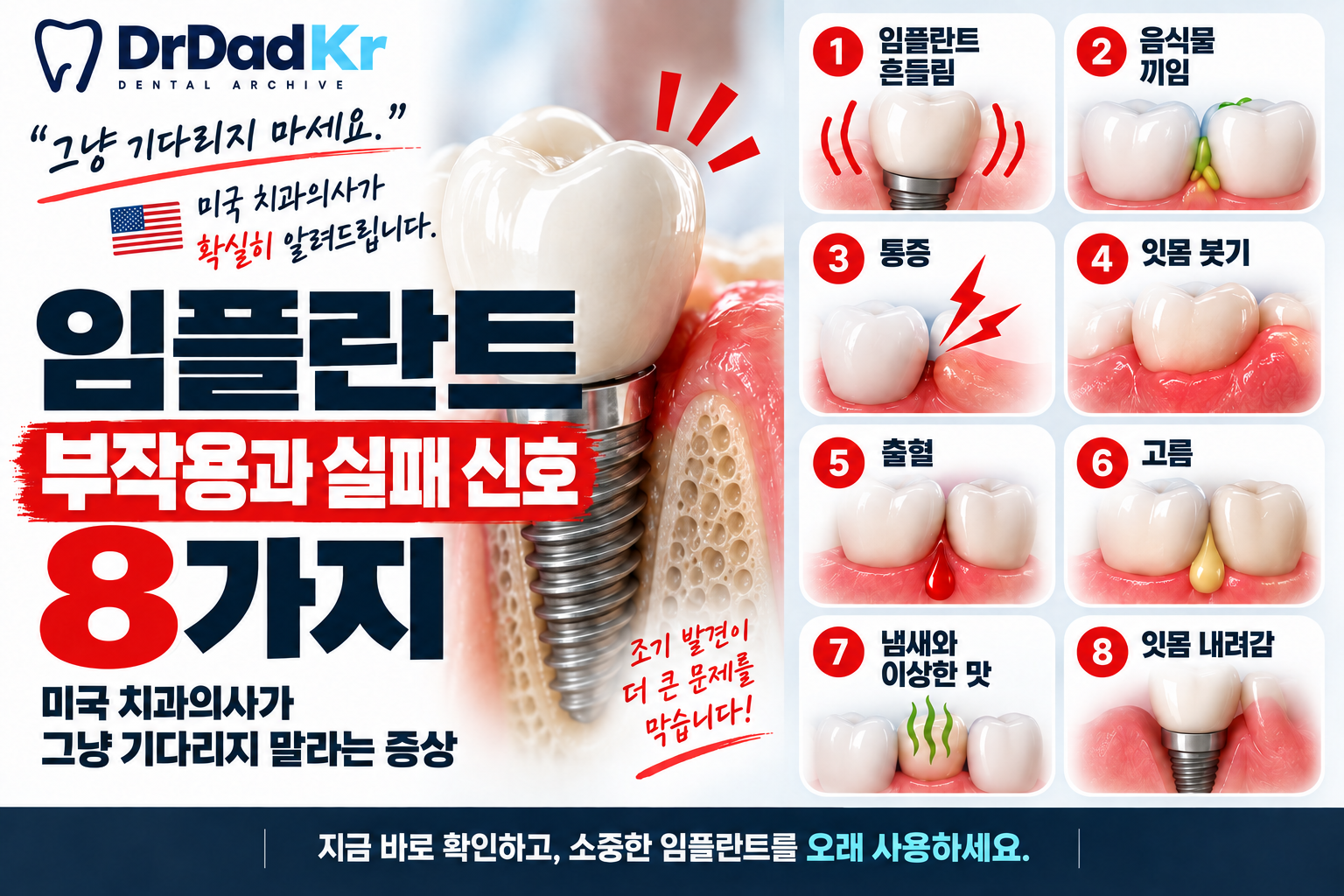 임플란트 부작용과 실패 신호 8가지|미국 치과의사가 ‘그냥 기다리지 말라’는 증상