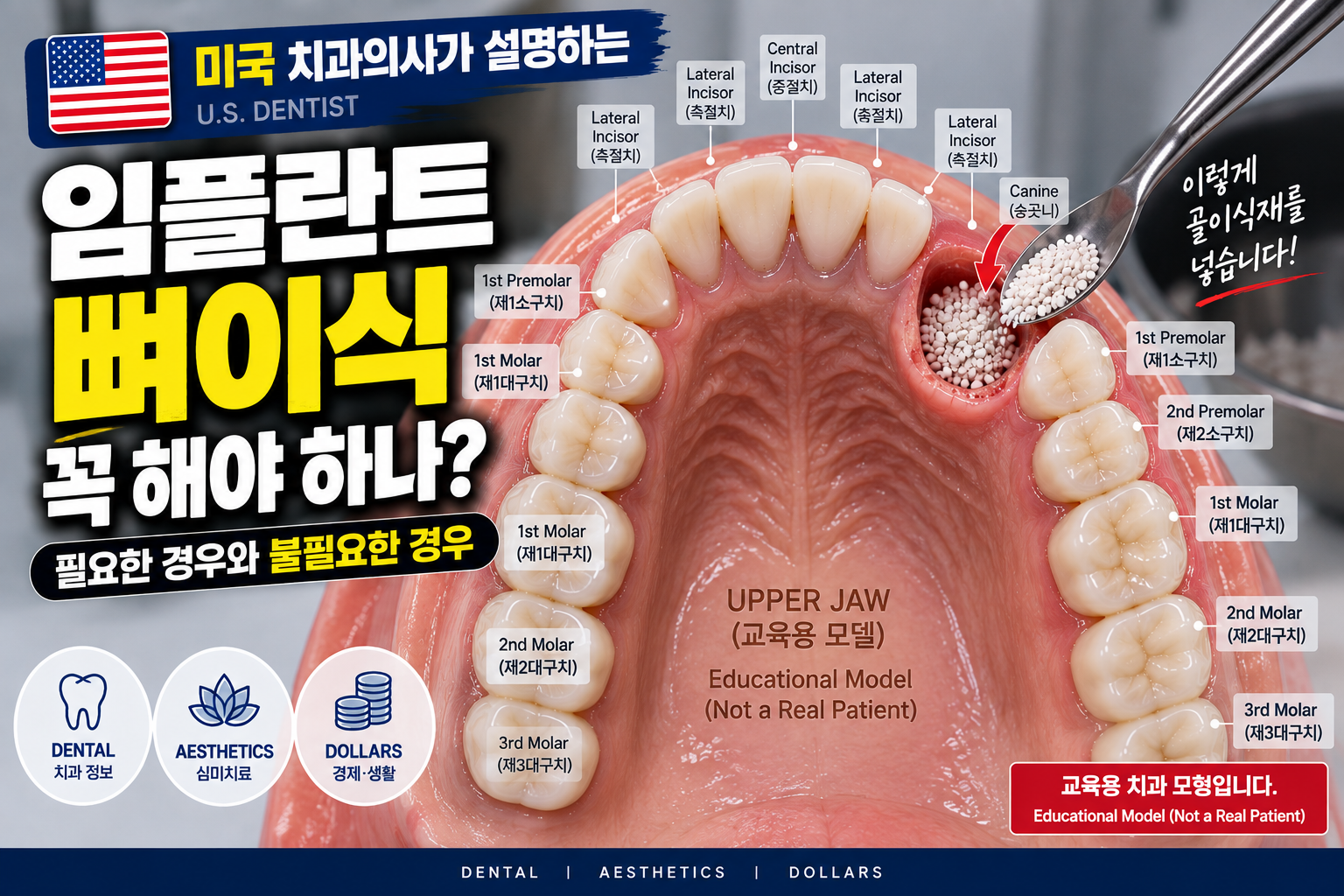 임플란트 뼈이식 꼭 해야 하나? 미국 치과의사가 말하는 필요한 경우와 불필요한 경우