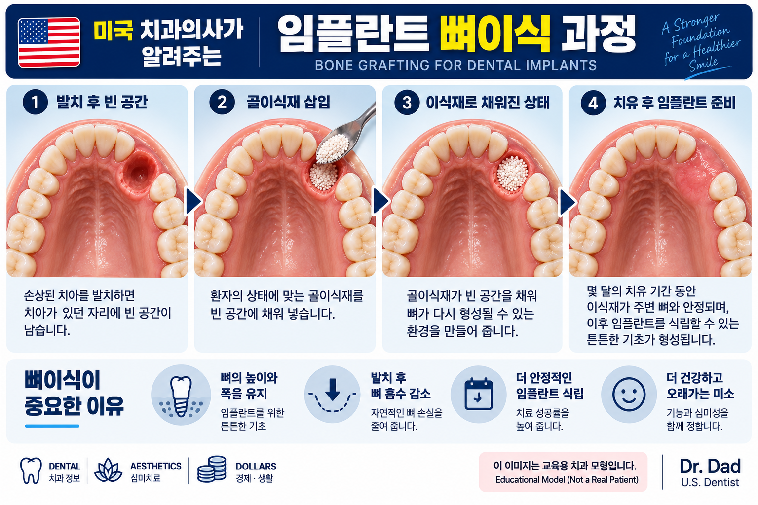 임플란트 뼈이식 과정 인포그래픽