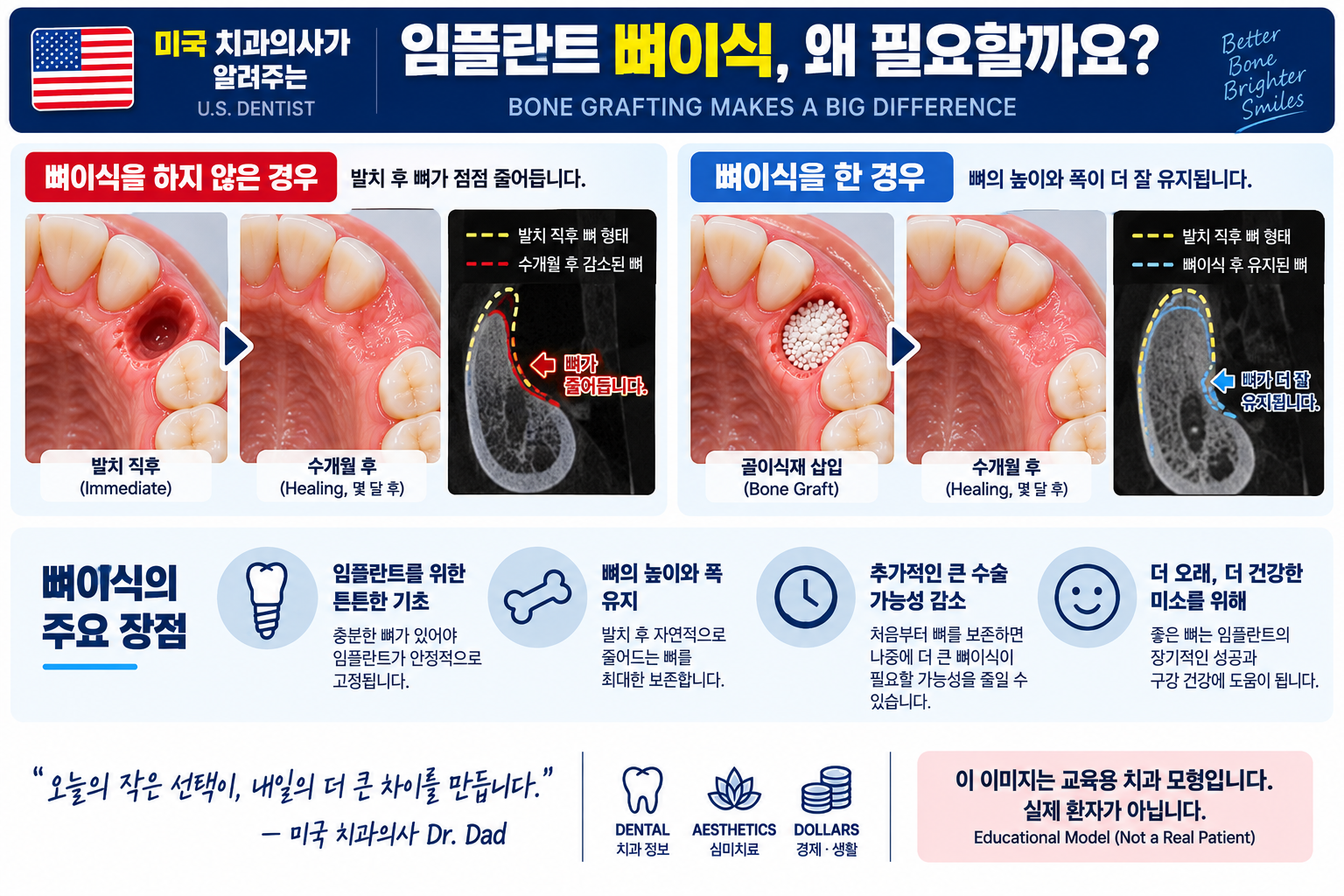 임플란트 뼈이식 필요성과 골흡수 비교 인포그래픽