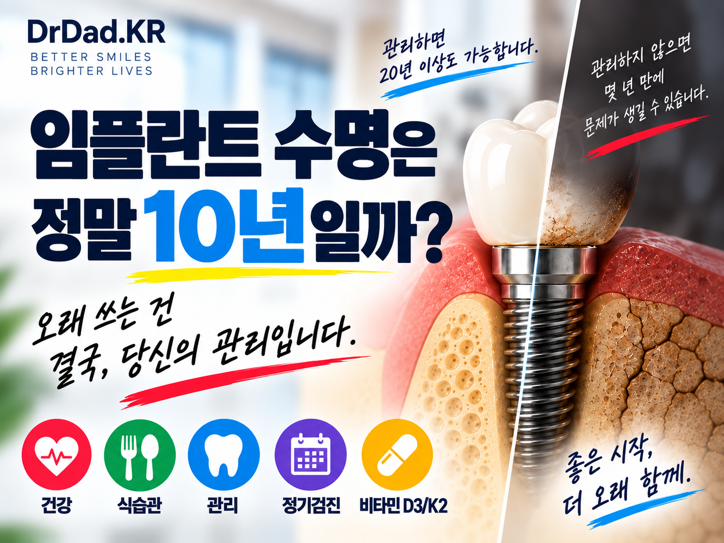 임플란트 수명은 정말 10년일까? 오래 가는 임플란트와 빨리 망가지는 임플란트